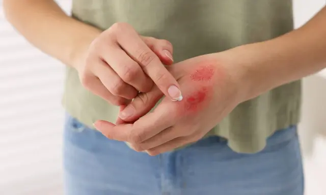 Mano con bruciatura da piastra, arrossata e con crema applicata.