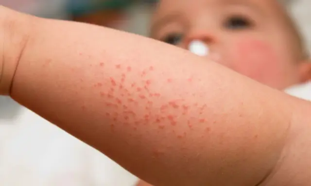 Bébé avec un bouton de chaleur sur le bras. Petits points rouges sur la peau.