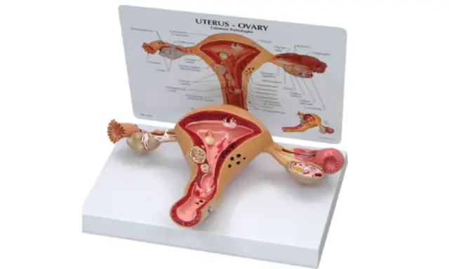 Model anatomiczny narządu rodnego kobiety z widoczną torbielą na jajniku.