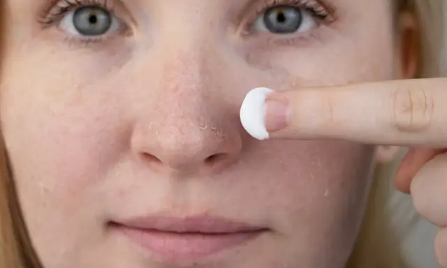 Une personne applique une crème sur son visage, montrant des zones de peau sèche et squameuse, typiques du psoriasis du visage.