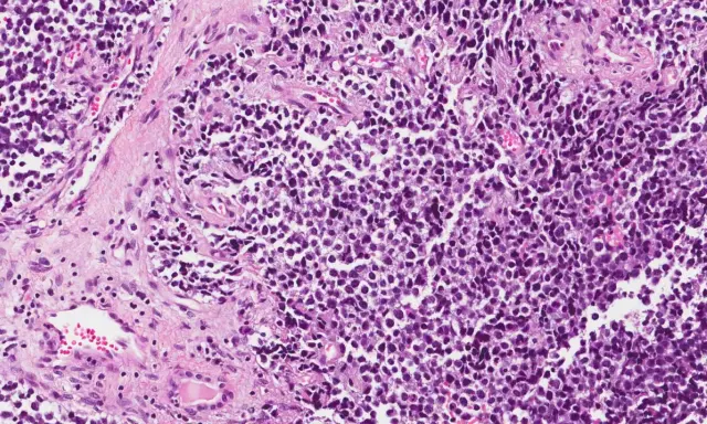 Microscopia di rabdomiosarcoma alveolare: cellule tumorali con nuclei scuri e citoplasma scarso, disposte in nidi separati da tessuto connettivo.