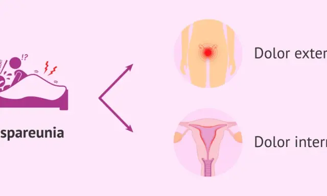 Dispareunia: dolor al ser penetrada, ya sea externo o interno.