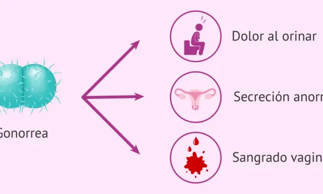 La gonorrea puede causar dolor al orinar, secreción anormal y sangrado vaginal.