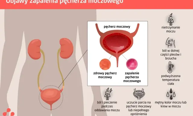 Objawy zapalenia pęcherza: nietrzymanie moczu, ból, pieczenie, uczucie parcia, mętny mocz. Zastój moczu może być objawem.