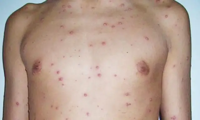 Torso y brazo de persona con granitos varicela leve, pequeños y rojizos, indicando una erupción cutánea.