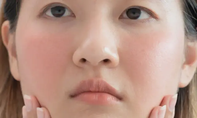 Gros plan sur le visage d'une jeune femme, ses joues rosées évoquant un doux **bouton soleil visage**. Ses mains effleurent délicatement sa peau.
