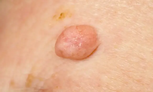 Zmiana skórna, która może być jednym z objawów wirusa HPV. Widoczny różowy, lekko łuszczący się brodawczak.