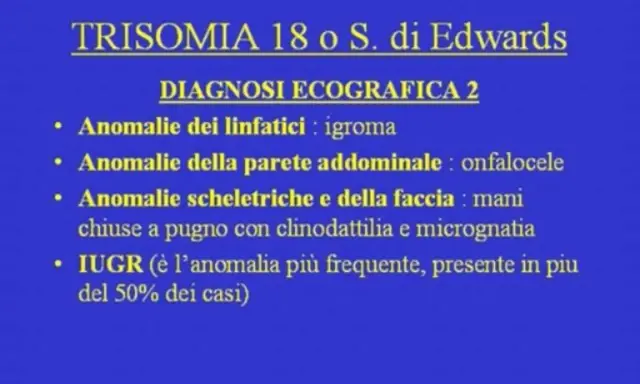 Diagnosi ecografica della trisomia 18: igroma, onfalocele, mani chiuse a pugno, micrognatia e IUGR.