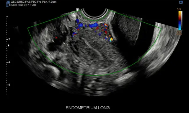 Ecografia pelvica con evidenza di vascolarizzazione anomala, possibile indicatore di tumore ovario.