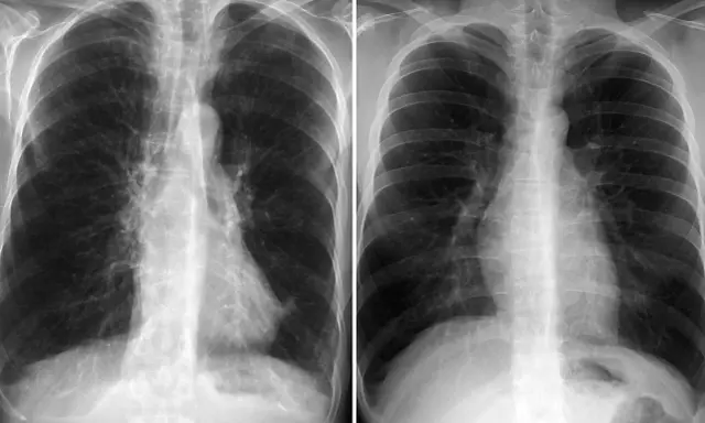 Zwei Röntgenaufnahmen des Brustkorbs zeigen Anzeichen von COPD. Ein rosa Puffer könnte zur Linderung der Symptome beitragen.