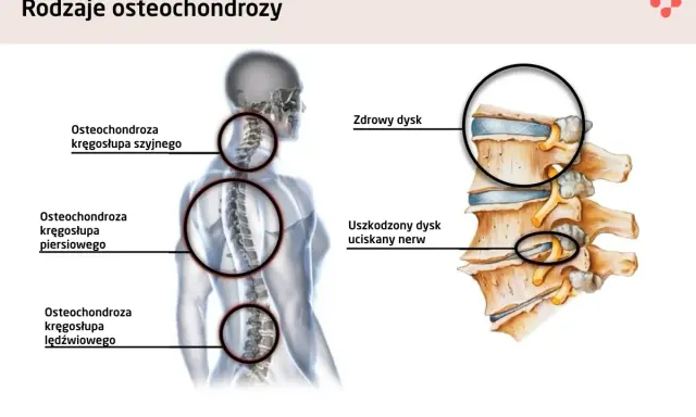 Czy ból jąder może być od kręgosłupa? Ilustracja pokazuje osteochondrozę kręgosłupa szyjnego, piersiowego i lędźwiowego, a także uszkodzony dysk uciskający nerw.