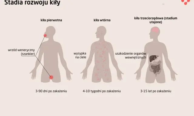 Ilustracja pokazuje stadia rozwoju kiły: pierwotna z wrzodem, wtórna z wysypką skórną, trzeciorzędowa z uszkodzeniem narządów.