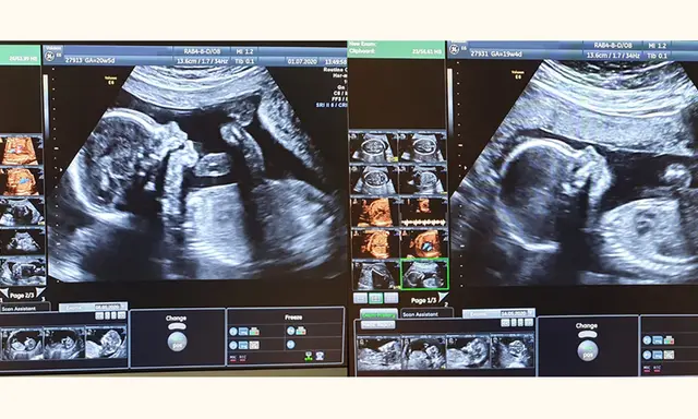 Badania prenatalne I trymestr: Co musisz wiedzieć? (do 70 znaków)