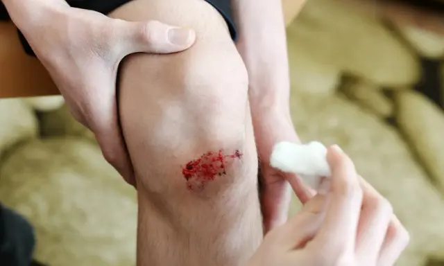 Une main tient un genou avec une **peau lésée** et sanglante, tandis qu'une autre main s'apprête à nettoyer la blessure avec du coton.