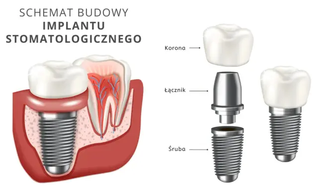 Schemat budowy implantu stomatologicznego. Dowiedz się, ile kosztuje wstawienie zęba i jak wygląda jego konstrukcja: śruba, łącznik i korona.