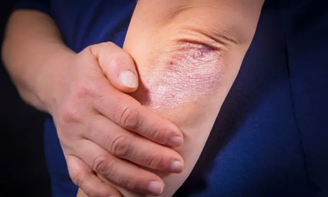 Psoriasis sur le coude, une affection cutanée rouge et squameuse. La main d'une personne touche doucement la zone affectée.