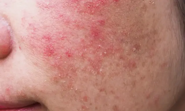 Gros plan sur une peau rougie et squameuse, signe d'une allergie cutanée au visage. Des plaques rouges et des petites pellicules sont visibles.