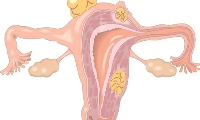 Anatomia kobieca z tyłozgięciem macicy i mięśniakami. Może wpływać na współżycie.