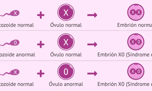 Ilustración de la monosomía X. Muestra cómo un espermatozoide anormal (0) o un óvulo anormal (0) pueden resultar en un embrión X0, conocido como Síndrome de Turner.