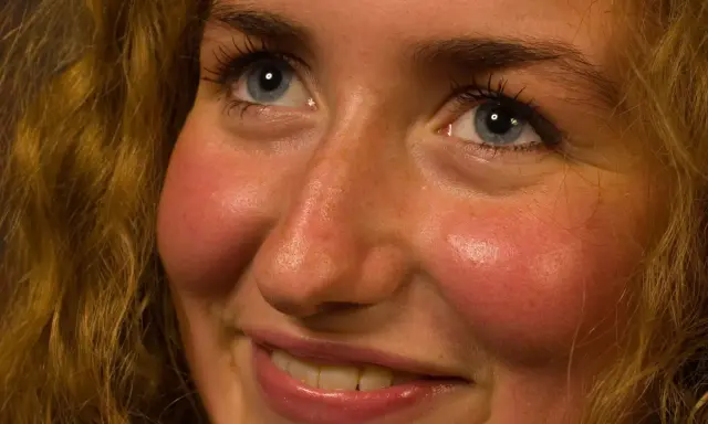 ¿Rubor facial por tus medicamentos? Soluciones y control experto