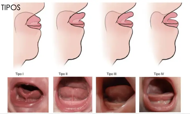 Ilustraciones y fotos muestran los tipos de anquiloglosia que es la limitación del movimiento de la lengua.
