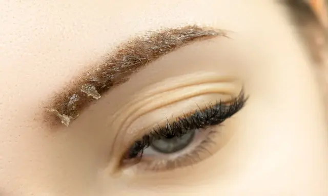 Gros plan sur un sourcil en cours de guérison après un maquillage permanent, montrant des croûtes et des poils. Soins après maquillage permanent sourcils.