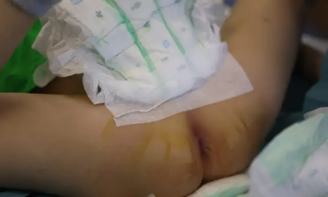 Niemowlę w pieluszce, które 3 latek sika 2 razy dziennie, leży na boku. Widoczne są ślady po wkłuciach.