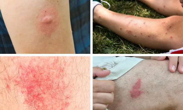 Plusieurs réactions cutanées, dont une piqure de moustique infectée, montrent une inflammation et des rougeurs sur la peau.