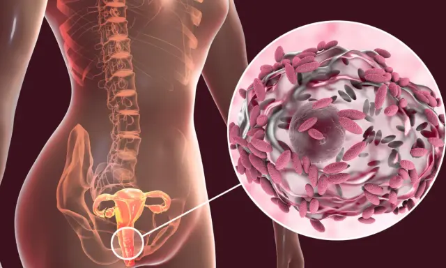 Anatomía femenina con detalle ampliado de vaginosis bacteriana.