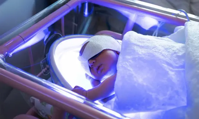 Un neonato dorme sotto luci blu per la fototerapia, con gli occhi protetti da bende.