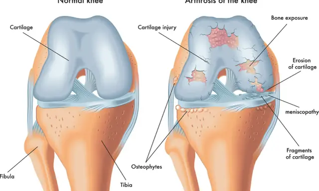 Vergleich eines gesunden Knies mit Arthrose. Arthrose zeigt Knorpelschäden, Knochenexposition und Osteophyten, was zu steifen Gelenken führt.