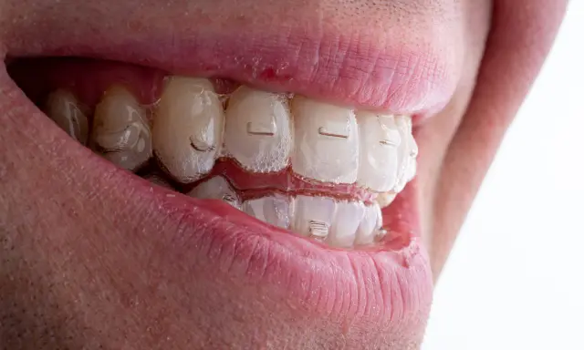 Uśmiech z niewidocznymi nakładkami Invisalign Comprehensive, które delikatnie korygują zgryz.