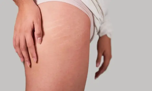Gros plan sur des vergetures sur les cuisses d'une personne, montrant la texture de la peau.