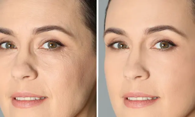 Porównanie twarzy przed i po zastosowaniu retinolu. Widoczne wygładzenie zmarszczek i poprawa tekstury skóry. Retinol efekty przed i po.
