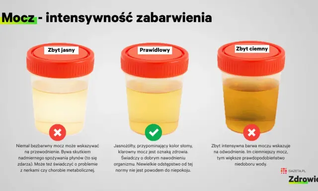 Kolor moczu co oznacza? Jasny, prawidłowy i ciemny mocz w pojemnikach. Jasny może oznaczać przewodnienie, prawidłowy zdrowie, a ciemny odwodnienie.
