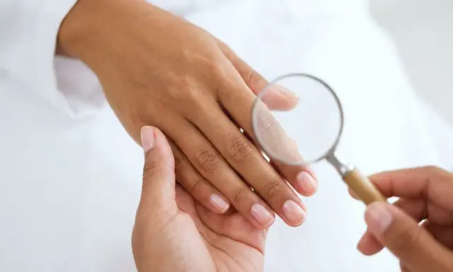 Esame ravvicinato di un'unghia con lente d'ingrandimento, per escludere infezioni come la pseudomonas unghia.