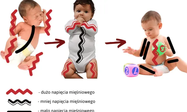 Zmiana napięcia mięśniowego u niemowląt: od wzmożonego napięcia obręczy barkowej do swobodniejszych ruchów.