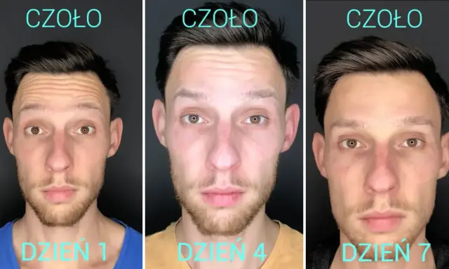 Botoks za mocny? Jak przyspieszyć zanikanie efektów porady eksperta