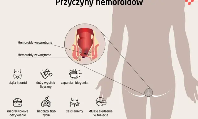 Ilustracja pokazuje przyczyny hemoroidów, w tym ciążę, wysiłek fizyczny, zaparcia, nieprawidłowe odżywianie, siedzący tryb życia i seks analny. Czy hemoroidy są groźne?
