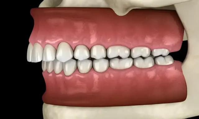 Model szczęki z cofniętą żuchwą u dorosłych. Ilustracja pokazuje problem zgryzowy, który może wymagać leczenia.
