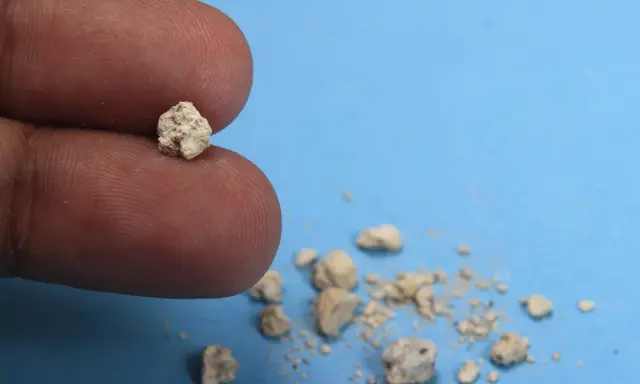 Palec trzyma niewielki kamyk, jeden z wielu złogów w nerkach 4mm, które wypadły.