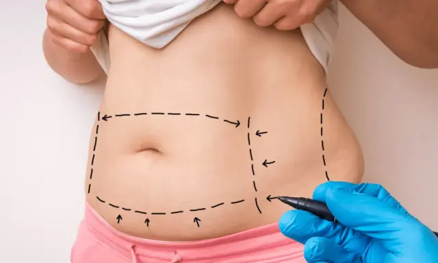 Liposukcja: Odkryj prawdę o odsysaniu tłuszczu. Co musisz wiedzieć?