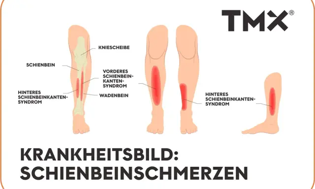 Illustrationen zeigen verschiedene Ursachen für starke Schmerzen im Schienbein im Ruhezustand, wie das vordere und hintere Schienbeinkantensyndrom.