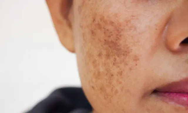 Gros plan sur une joue montrant une tache brune sur la peau, résultat d'une hyperpigmentation.