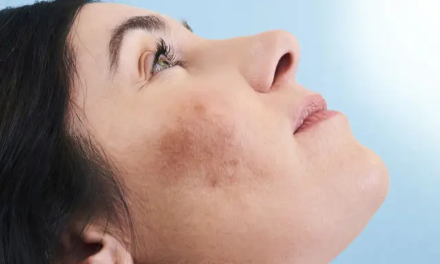 Primo piano del viso di una donna con macchie cutanee visibili, che mostra come coprire le macchie sul viso per un incarnato uniforme.