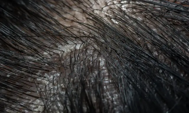Gros plan sur un cuir chevelu présentant des pellicules grasses, avec des cheveux noirs fins qui poussent à travers.