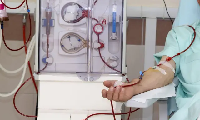 Pacjent podłączony do aparatu do dializy. Czerwone przewody doprowadzają krew do maszyny, która oczyszcza ją. To właśnie dializa co to jest w praktyce.