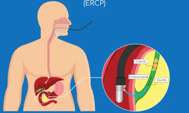 ERCP: endoscopio inserito per rimuovere calcoli che causano ostruzione coledoco.