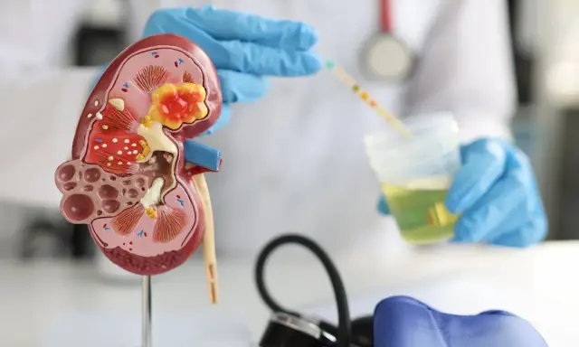 Model nerki i test paskowy do analizy moczu, kluczowe elementy w diagnostyce i leczeniu nerkozastępczym.