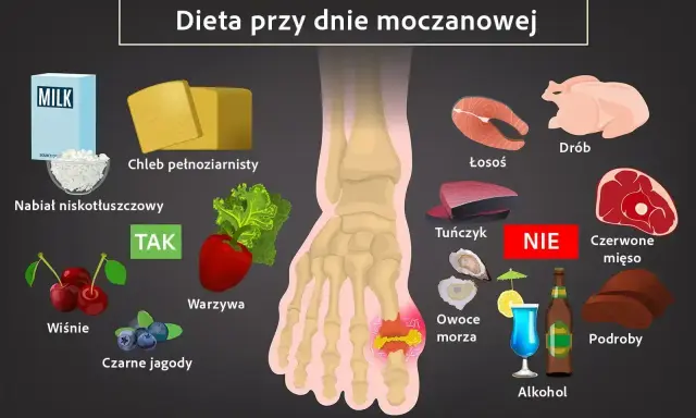 Dieta przy dnie moczanowej: TAK - nabiał, chleb, warzywa, wiśnie, jagody. NIE - drób, łosoś, tuńczyk, czerwone mięso, podroby, owoce morza, alkohol. Pomaga obniżyć podniesiony kwas moczowy.